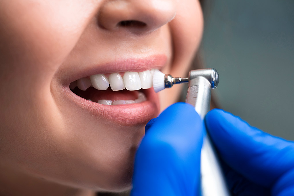Limpieza dental profesional en Guayaquil